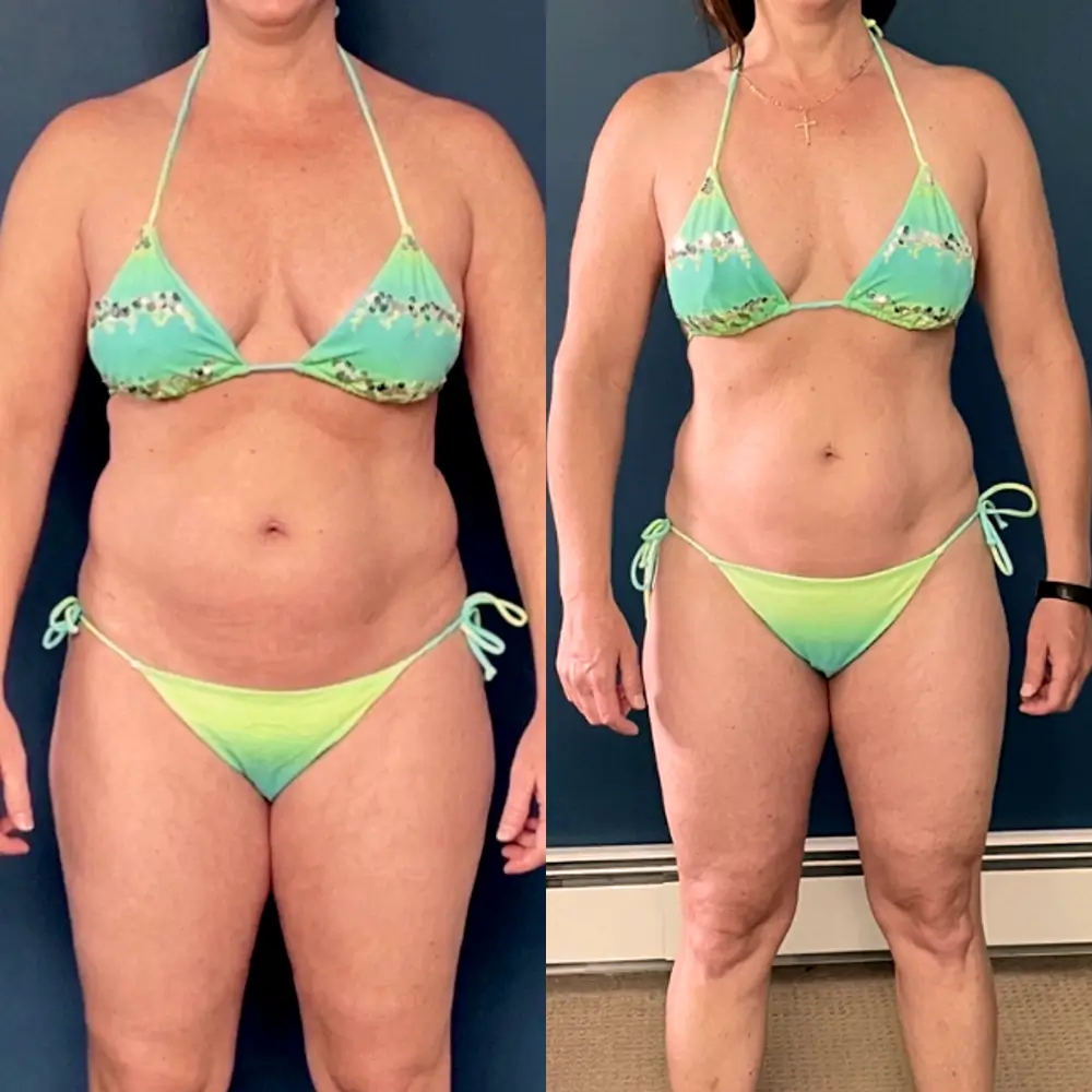 Christine - Team Biolayne | Before/After